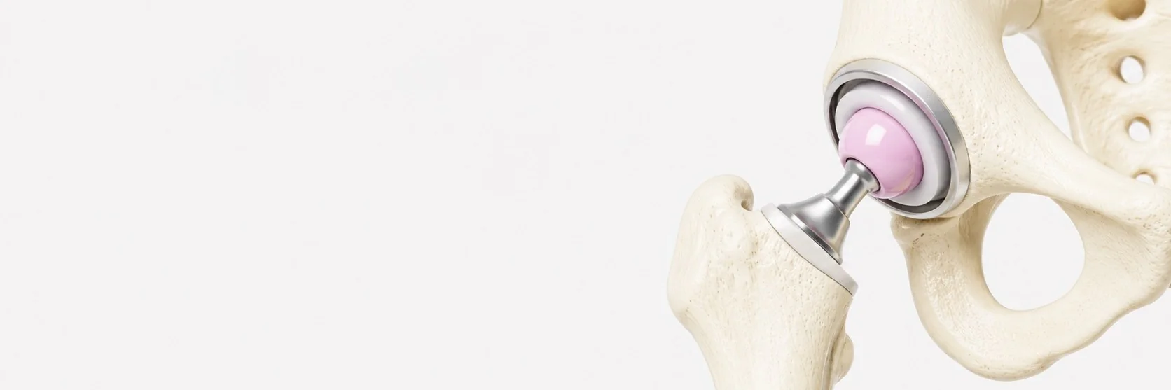 Total Hip Replacement